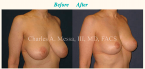 Dr. Charles Messa - How Can Breast Reduction Surgery Change Your Life?
