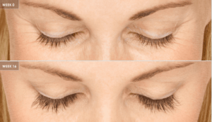 Benefits of Latisse®