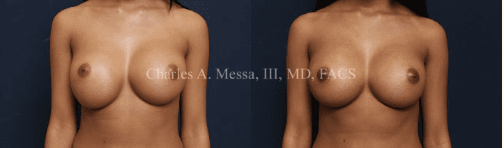 Breast Secondary Corrective Surgery Before and After