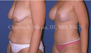 Dr. Charles Messa - Tummy Tuck Recovery Guide