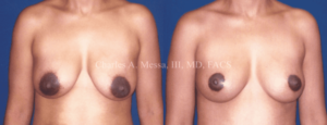 Dr. Charles Messa - What Can I Achieve With Breast Lift Surgery?