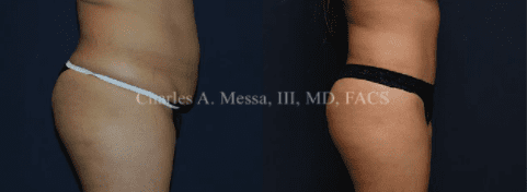 Dr. Charles Messa - What Is the Best Treatment for a Postpartum Pooch?