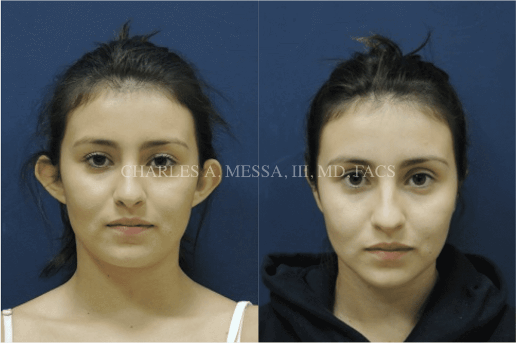 Dr. Charles Messa - Downsize Your Ears With Otoplasty