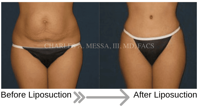 Patient Before and After Liposuction on Abdomen