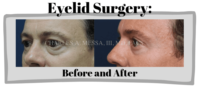 Dr. Charles Messa - Improve Your Appearance With Eyelid Surgery