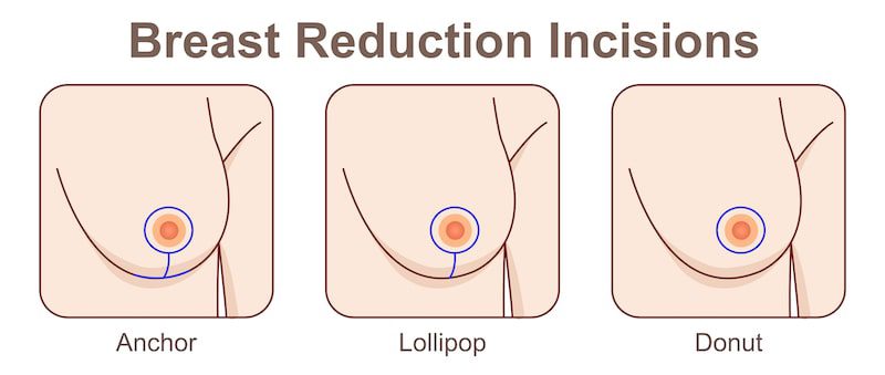 Illustration of the three different incision options available for breast reduction: anchor, lollipop, and donut.