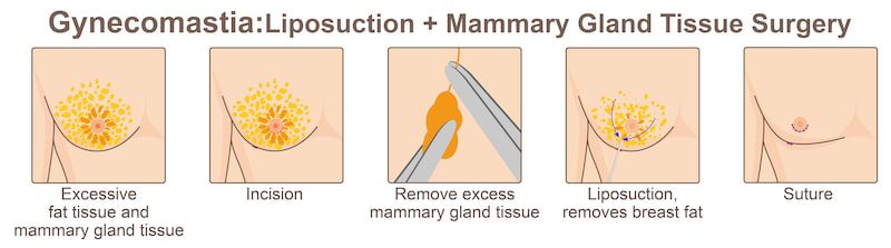 Illustration of male breast reduction surgery techniques.
