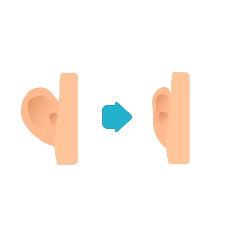 Illustration demonstrating what is done during an ear pinning surgery.