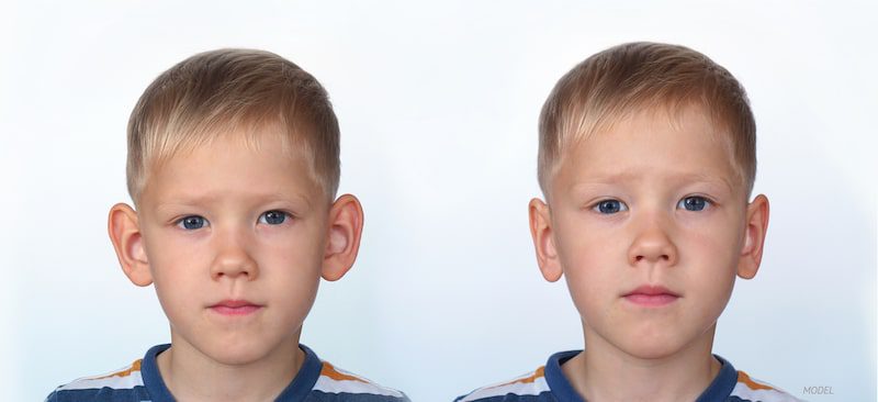 Young boy before an after an ear pinning surgery.