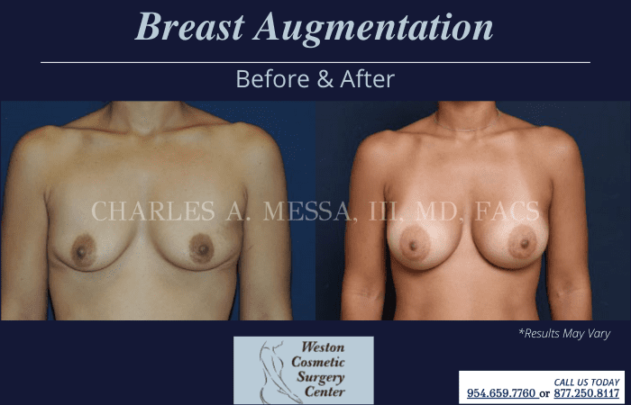 https://westoncosmeticsurgery.stagepss.com/photo-gallery/breast-augmentation/