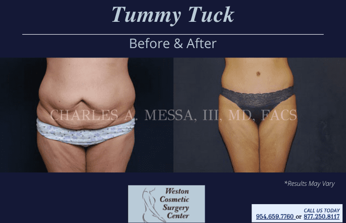 Before and after image showing the results of a tummy tuck performed in Weston, FL.